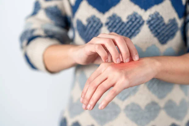 psoriasis